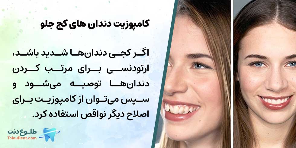 کامپوزیت دندان جلو کج