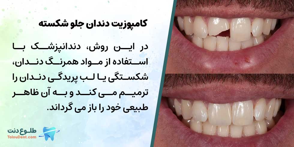 کامپوزیت دندان جلو شکسته
