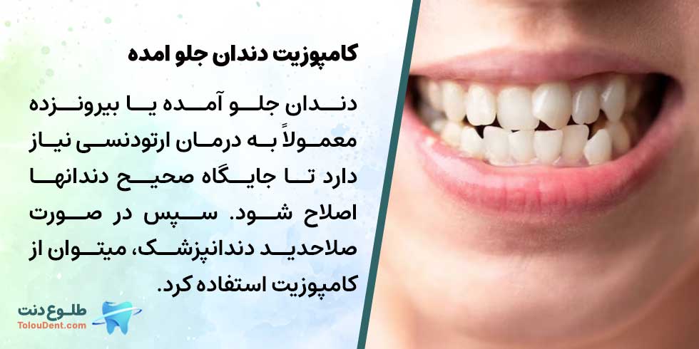 کامپوزیت دندان جلو امده