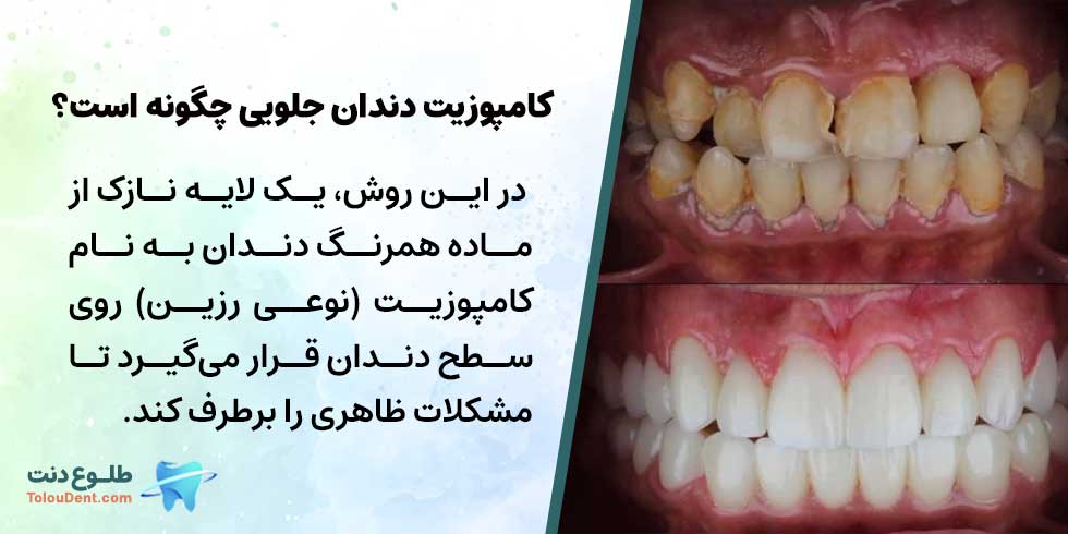 کامپوزیت دندان جلویی چگونه است؟