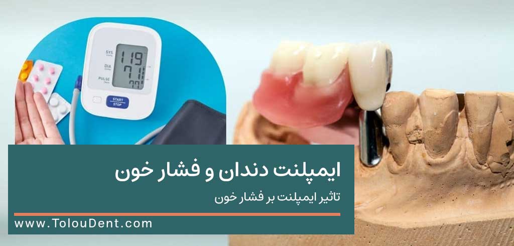 ایمپلنت دندان و فشار خون