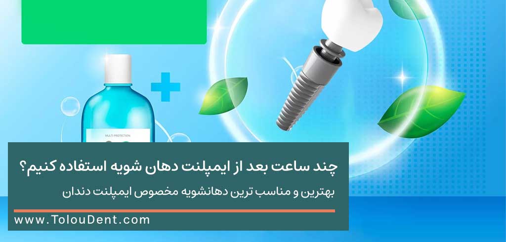 چند ساعت بعد از ایمپلنت دهان شویه استفاده کنیم؟