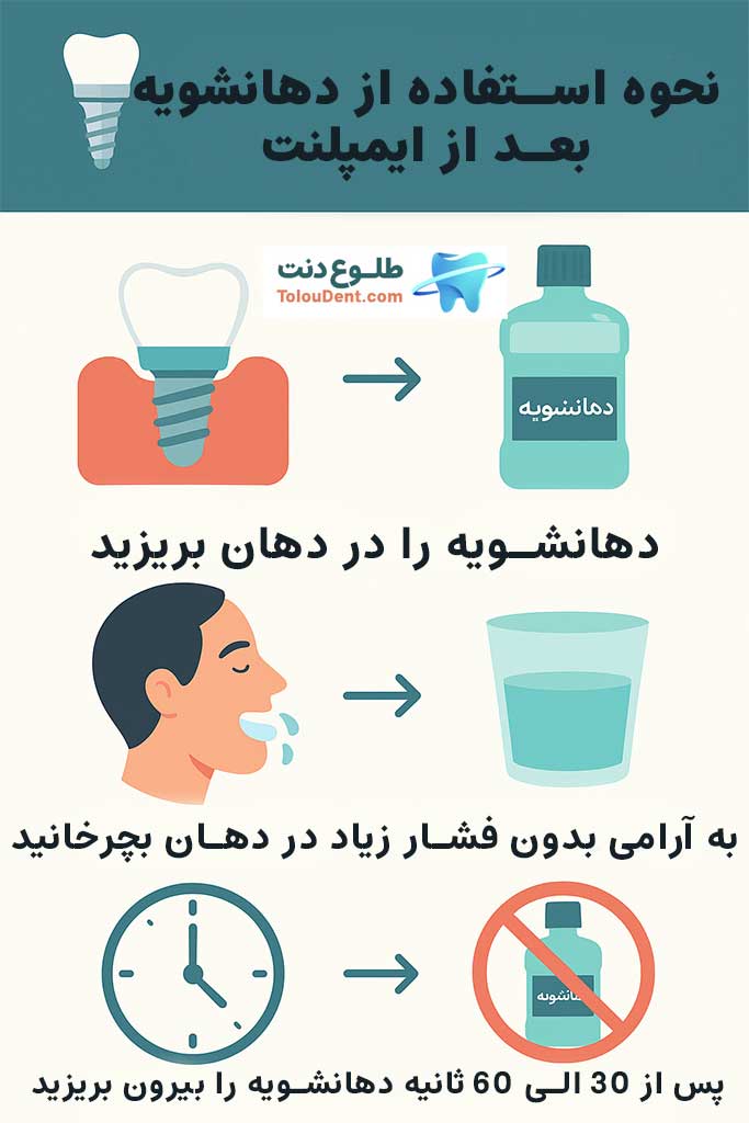 نحوه استفاده از دهانشویه بعد از ایمپلنت