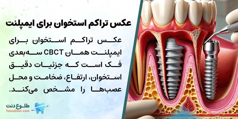 عکس تراکم استخوان برای ایمپلنت